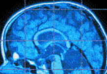 Women risk more Cerebral vascular accidents Women risk more Cerebral vascular accidents